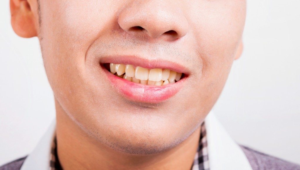 Man with yellow teeth and an overbite