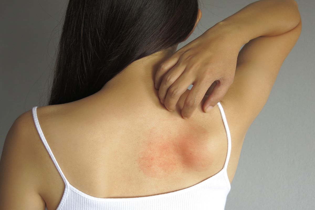 woman rash back