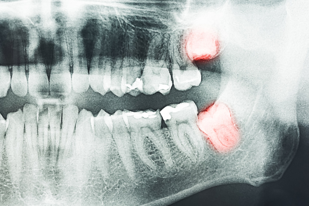 a panoramic xray of the teeth