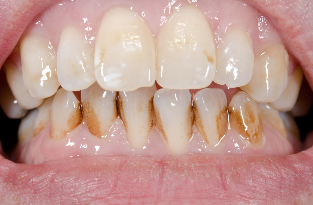 An open bite patient's mouth with upper teeth not aligning properly with the lower ones